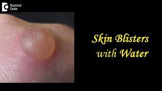 Skin Blisters with Water Causes Treatment Draining Prevention - Dr.Aruna Prasad  Doctors Circle