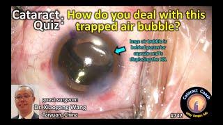 Cataract Quiz How do you deal with this trapped air bubble?