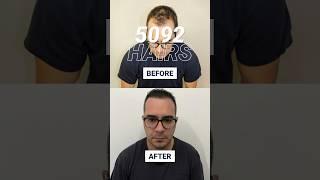 How natural will your hairline look after the hair transplant? Check out Rafaels result