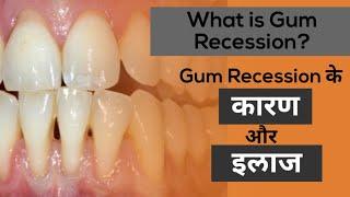 What is Gum Recession? मसूड़े नीचे जाने के कारण और उसके इलाज