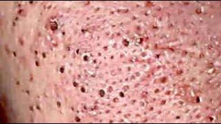 DR Skincare #acne #blackheads#whiteheads #Treatments #pimple# Part 8 Full Screen HD