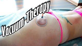 Massage Therapy - Anti Cellulite Vacuum Cupping Procedure
