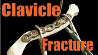 Fixing CLAVICLE FRACTURES