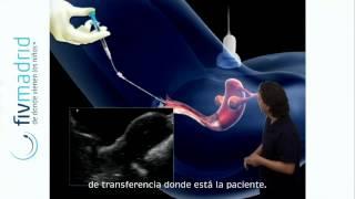 Transferencia embrionaria en FIV
