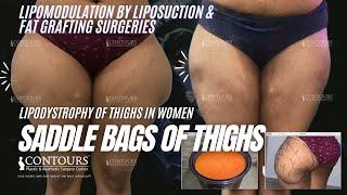 SADDLE BAG DEFORMITY of THIGH  WOMEN THIGH CELLULITE  LIPODYSTROPHY  LIPOSUCTION  CONTOURS