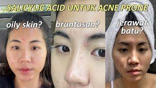 UPDATE SKINCARE for oily and acne prone skin