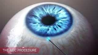 Ophthalmology glaucoma IOP drainage animation