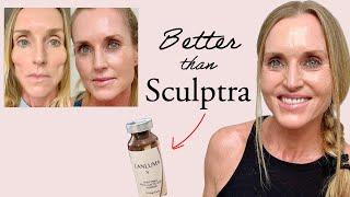 How I finally reversed my Facial FatVolume Loss without Filler   Lanluma vs Sculptra