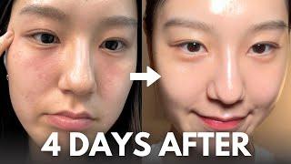 How I repair my skin barrier in 4 days at home with affordable skincare routine