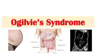 Ogilvie Syndrome  Pseudo-Obstruction of the Large Intestine Causes Symptoms Diagnosis Treatment