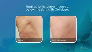 Cellulaze - Laser Cellulite Treatment