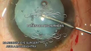 RHEXIS IN INTUMESCENT CATARACT