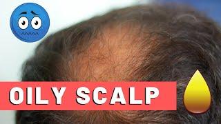 Oily Scalp Treatment For Hair Loss The Best Way