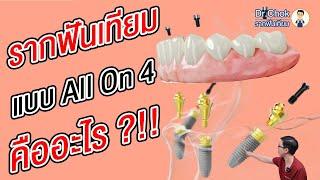 ฝังรากฟันเทียม แบบ All On 4 เปลี่ยนชีวิต l คลายปัญหารากฟันเทียมกับหมอโชค