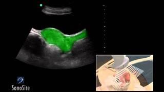 How To Female Pelvis Ultrasound Exam 3D Video