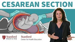 What is a cesarean section? OBGYN answers 13 common questions about c-sections  Stanford