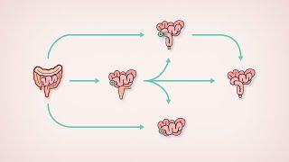 Surgical treatment for Ulcerative Colitis  Patient Education  TVASurg