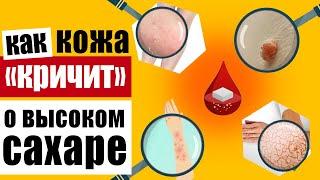 Предупреждающие признаки на коже которые говорят о высоком уровне сахара в крови