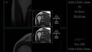 MRI – FAST SHOULDER wDRB