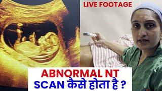 Abnormal NT Scan  Nuchal translucency NT scan  Live demo -Dr Asha Gavade