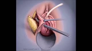 Urethrolysis and Martius flap for urinary stress incontinence with fixed urethra