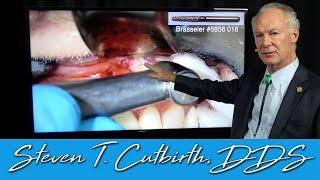 Endodontics & Apicoectomy on a Lateral Incisor - Dental Minute with Steven T. Cutbirth DDS