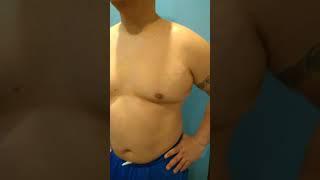 Pseudogynecomastia Pre-Op Vaser Hi-Def PowerX Lipo Gland Removal & J-Plasma  by Dr. Lebowitz NY