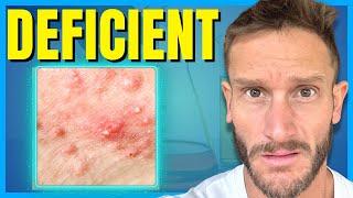 The #1 Cause of Acne in Adults how to stop it