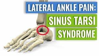 Sinus Tarsi Syndrome - One Cause of Lateral Ankle Pain