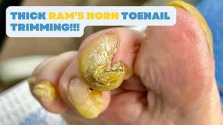 Thick RAM’S HORN TOENAIL Trimming