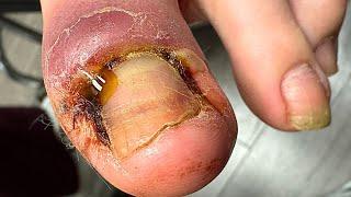 PLUGGED-UP Infected Ingrown Nail Removal