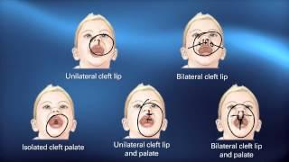 Cleft Diagnosis - Pediatric Playbook - Boston Childrens Hospital