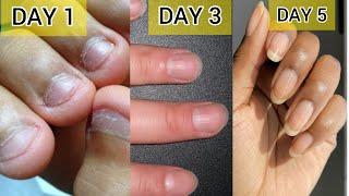 कितने भी खराब नाखून हो बस 5 दिन में सुंदर लम्बे होंगे*GROW NAILS FASTER AT HOME*