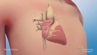 Understanding Atrial Septal Defect ASD