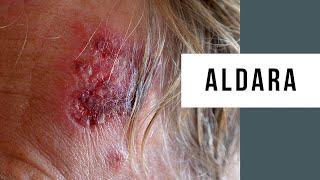 Skin Cancer Treatment Using Aldara Cream