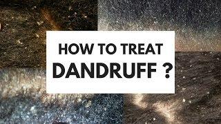 HOW TO TREAT DANDRUFF