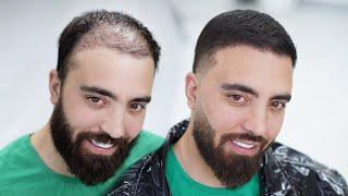 How Barber Transformed Thin & Balding Hair with Hair Fibers