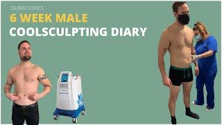 COOLSCULPTING Is It *WORTH* It ?  Male CoolSculpting Diary At Quinn Clinics Bristol