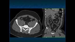 CT Evaluation of the Appendix Appendicitis and Beyond - Part 1