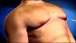 Gynecomastie - Opération des seins trop gros de lhomme   Chirurgie esthétique  Label esthétique