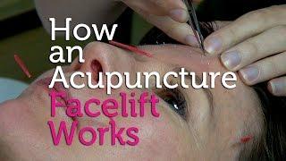 How an Acupuncture Facelift Works