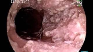 Endoscopic Imaging of Esophageal Verrucous Carcinoma