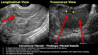 Intramural Fibroid Ultrasound Report Example  Uterine Leiyomyomas  Uterus Sonography  Radiology
