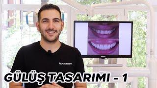 Gülüş Tasarımı Nasıl yapılır? Vaka İnceleme  DOCTORDENT