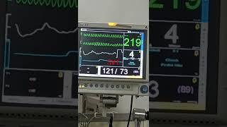 ventricular tachycardia in cardiac monitor