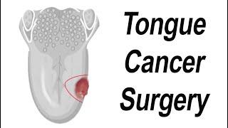 Surgical Removal of Tongue Cancer Animation