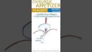 CHIRURGIE APPetizer REAGIERT Upside Down Stomach vs. Thoraxmagen