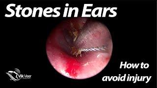 How to remove a stone from an ear and how not to