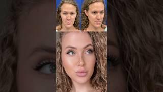 FACIAL FEMINIZATION SURGERY Via @drharrisonlee  #feminization #surgeryresults #beforeandafter