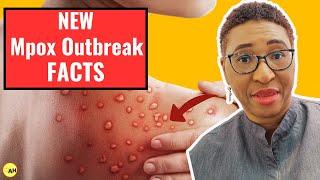 2024 Monkey Pox Mpox Outbreak is DIFFERENT - Heres Why